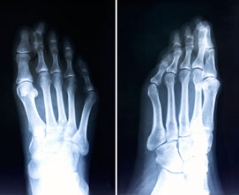 Лечение деформаций стопы и пальцев ног