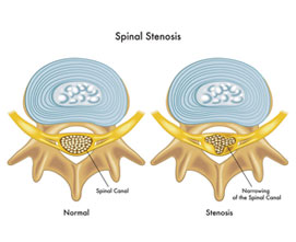 Методы лечения стеноза позвоночного канала
